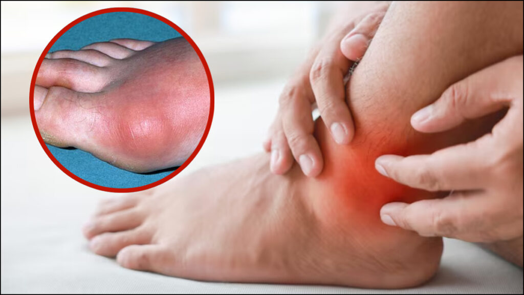 Uric Acid बढ़ने का पहला लक्षण और शरीर पर असर
