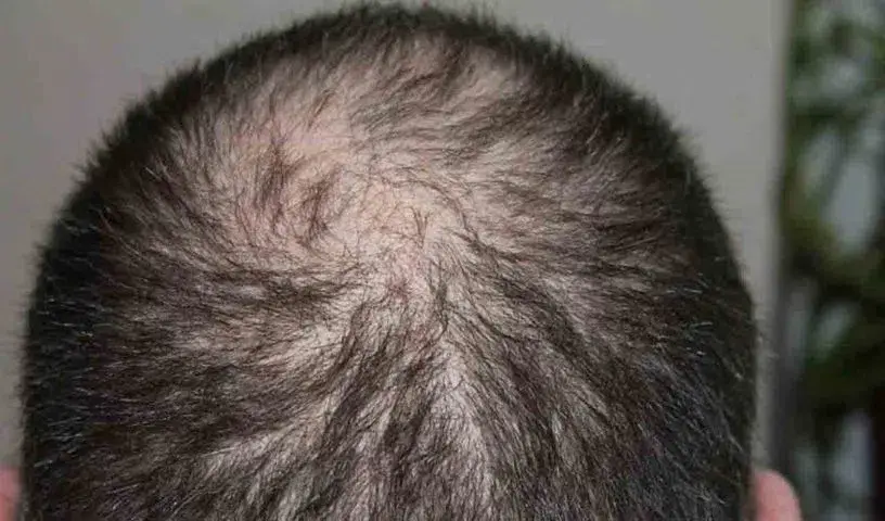 Notice : डेंटल सर्जनों के पास बाल प्रत्यारोपण करने के लिए प्रशिक्षण का अभाव