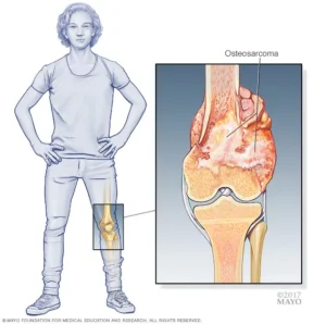Bone Cancer के लक्षण और शुरुआती संकेतों की पहचान