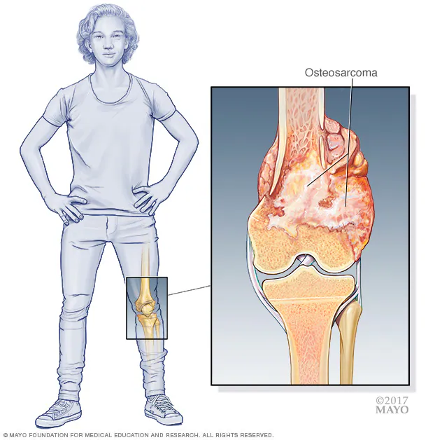 Bone Cancer के लक्षण और शुरुआती संकेतों की पहचान