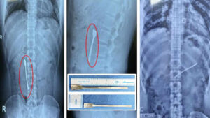 डॉक्टरों ने की दुर्लभ सर्जरी, 30 मिनट में मरीज के पेट से निकाली 8 सेमी की लंबी स्पून