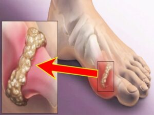 Uric Acid बढ़ने का पहला लक्षण और शरीर पर असर