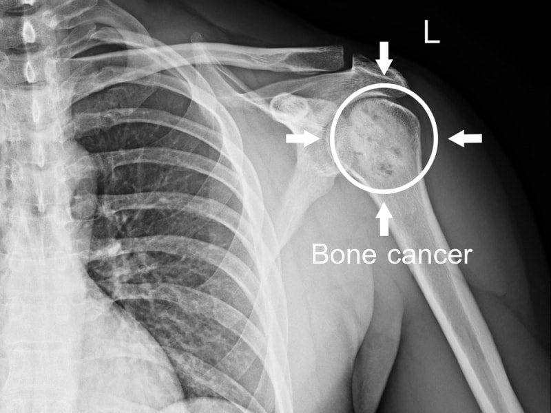 Bone Cancer के लक्षण और शुरुआती संकेतों की पहचान