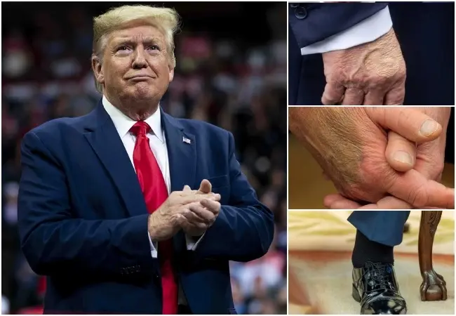 Donald Trump : पैरों में सूजन, हाथ पर निशान, किस बीमारी से पीड़ित है ट्रंप?