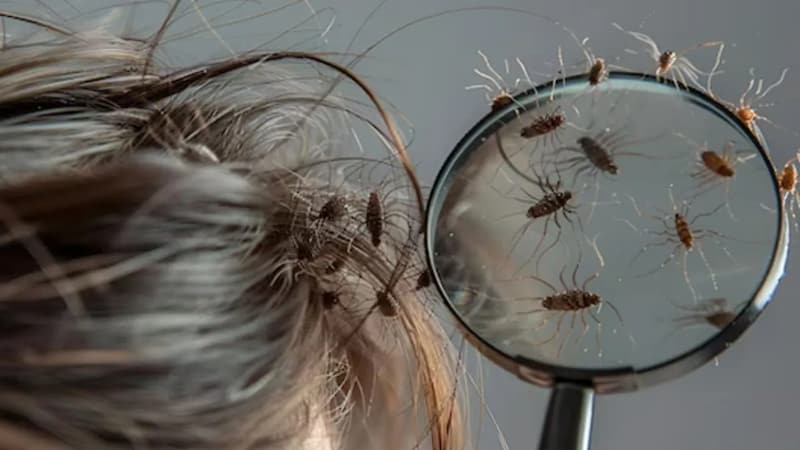 Hair Care Tips: जूं-लीख से बचने के लिए स्कैल्प को ऐसे रखें साफ