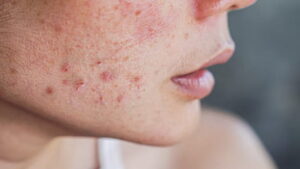 Skin Care: ऑयली स्किन और पिंपल्स की समस्या से पाएं छुटकारा, फॉलो करें ये टिप्स