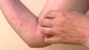 Chikungunya : WHO की चेतावनी से तेलंगाना में चिंता