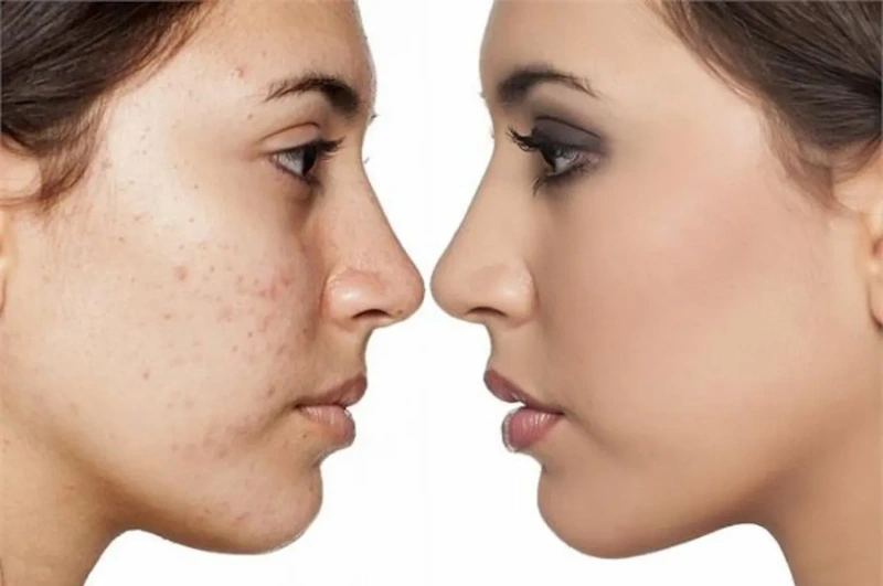 Beauty Tips: स्किन केयर में फायदेमंद है हरड़