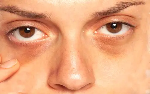 Health- आंखों की समस्या को न करें इग्नोर, हो सकता है गंभीर खतरा